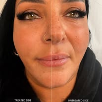 Facial treatment, visible glow before and after